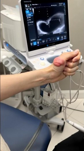 How do I get rid of my ganglion cyst? #painmanagement #painrelief #ai
