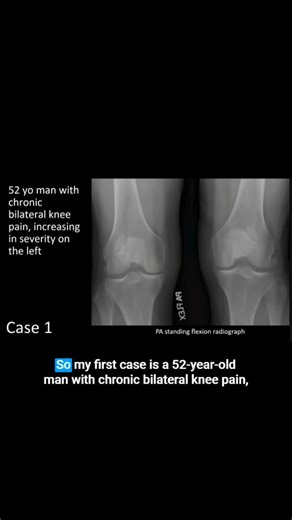 This lecture, Rapid Fire: Normal Variants/Congenital/Developmental was presented by Hillary Garner, MD as part of the ARRS Online Course, Case Review of Musculoskeletal Imaging. Save 20% on all of our online courses with code SUMMER20. Order now: arrs.org/ARRSLIVE/StandAlone/ARRSLIVE/Education/OnlineCourses/OC_CRMK23.aspx | ARRS | Facebook