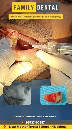 Painless Wisdom Tooth Extraction #hyderabad #dental #painrelief