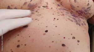 doctor dermatologist examines woman covered with lot of big enormous nevuses, large accumulation of warts and growths on her chest, possible symptom of cancer. closeup macro 4k video footage