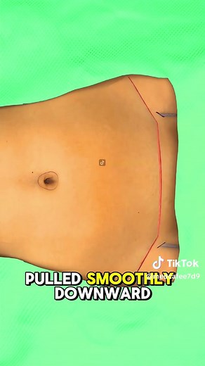 Tummy Tuck Surgery Explained: 3D Animation Guide