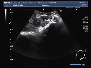 Ultrasound Video showing Ovarian ( Chocolate ) Cyst.