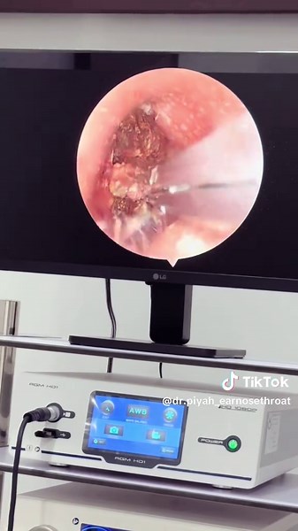 คลินิกหูคอจมูก: การรักษา Cholesteatoma อย่างมืออาชีพ
