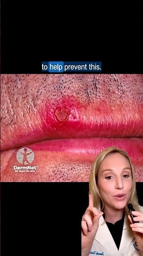 Did you know you can get skin cancer HERE?