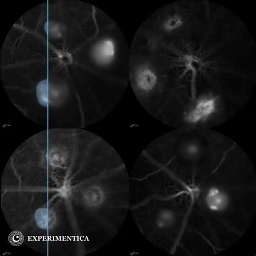 Fluorescein angiography and vascular leakage detection in a mouse choroidal neovascularization (CNV)