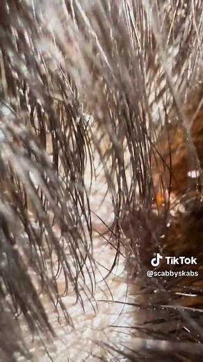 Head Scab Removal - Satisfying Video of Scabs Being Picked Off