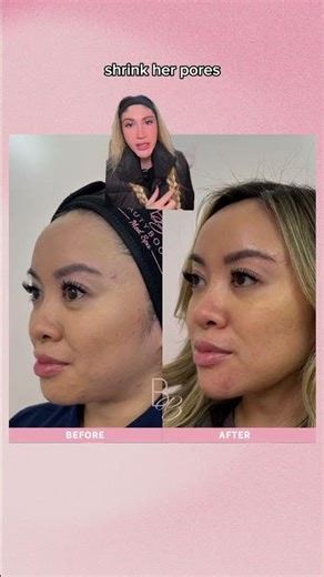 Showing what Masseter Tox, MicroTox & a Nefertiti Neck Lift can do! 👏🏼✨
