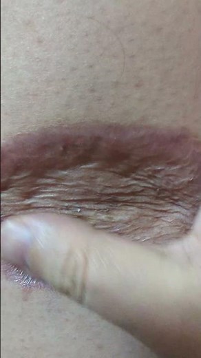 2/8 Today's rare cancer melanoma and Opdivo side effects (´・ω・`)