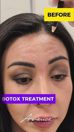 Before and 2 Weeks After Botox Treatment | Avance Plastic Surgery Institute: Dr. Erez Dayan