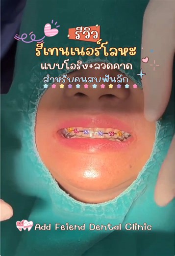 กดสบลึก ฟันสั้น ก็ทำรีโลหะได้🤩 บนรีโอริง ล่างรีแบบเชน ก็สวยเป๊ะได้เหมือนกัน ปรึกษาฟรี📌 สนใจทัก Inbox ได้เลยนะคะ มี 4 สาขา 📍สาขาพญาไท 📍สาขาราชพฤกษ์ 📍สาขาศาลายา 📍สาขาท่าพระ #คลินิกทันตกรรม #รีเทนเนอร์ #รีเทนเนอร์โลหะ #รีเทนเนอร์ใส่ทานข้าวได้ #รีเทนเนอร์เปลี่ยนยาง