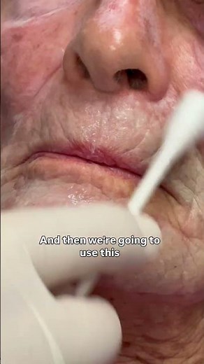 Dermatologist with 50 years experience goes over aftercare for full face deep chemical peel (pt. 8)
