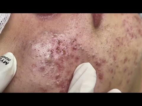 Mylinh . Most Satisfying Pimple Popping Ever #550