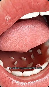 Why Do Some People Have Extra Teeth? 🦷 Explain Hyperdontia #hyperdontia #extrateeth #dentalfacts #teethgrowth #creativelearning3d | Arifkhan3ds
