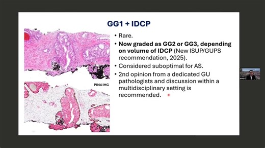 .@GladellPaner, MD, @UChicago, reviews novel pathological factors in #ProstateCancer, including cribriform glands, IDCP, and evolving grading strategies.#Pathology #Urology #Recurrent