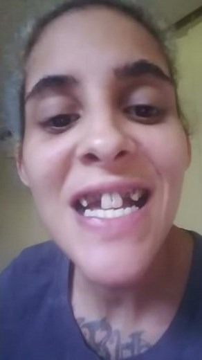 INCREDIBLE Smile Transformation | Missing Teeth | Instasmile Review