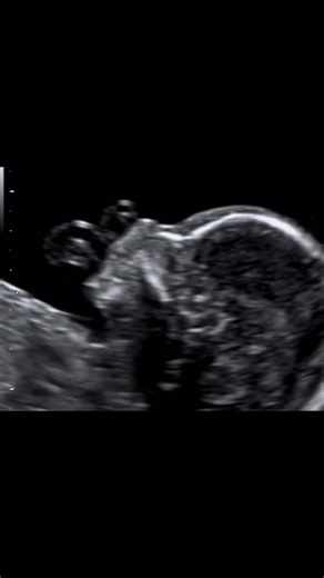 Do you know which ultrasound planes are required to perform a correct exploration of the face? Sagittal and fronto-coronal planes will allow you to see: - Profile: presence of nasal bone, fronto-nasal angle, naso-mental alignment - Orbits: present, symmetrical, correctly positioned, crystalline - Integrity of the lip and nose - Absence of cervical masses Acquire the skills, knowledge and training to recognize, classify and diagnose the majority of the anomalies that we can detect in an ultrasoun