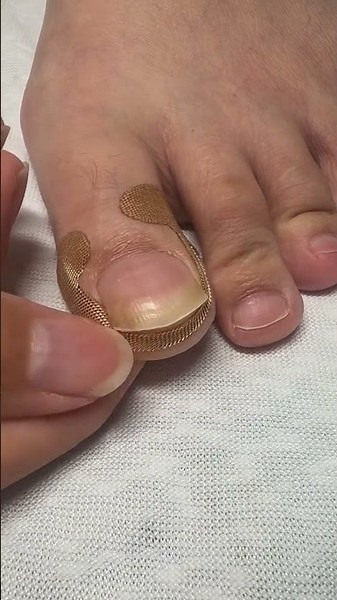 Say Goodbye to Ingrown Toenails with These Simple Stickers( # 2609 ) 1️⃣