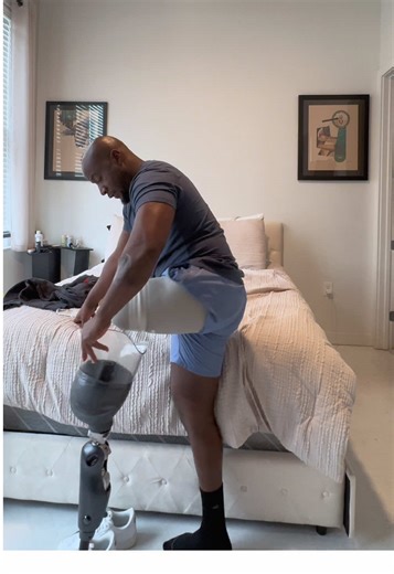 Life as an Amputee: Overcoming Daily Challenges