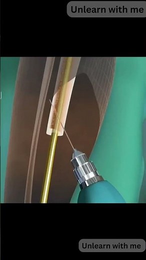 Intermedial Knee Surgery: Procedure, Recovery & Patient Guide