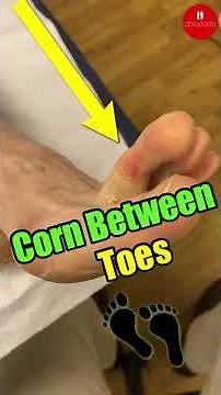 Remove Corn between Toes with Scalpel: Easy and Effective