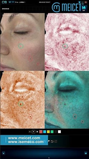 ISEMECO 3D D9 Skin Analyzer Compare Function
