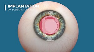 The Scleral Tuck IOL - Eyetube