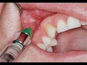 Local Infiltration Technique