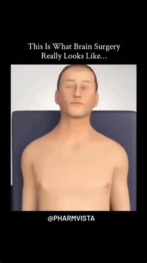 PharmVista Official | 🧠⚡ Craniotomy: When surgeons need to access the brain A craniotomy is a surgical procedure where doctors temporarily remove a portion of... | Instagram
