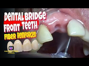 Dental Bridge Front Teeth