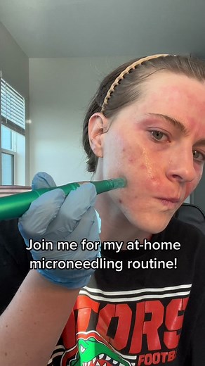 Do your own research before microneedling at home and perform at your own risk. I did a lighter treatment today (0.25-0.5mm) because im breaking out. I would recommend doing this when your face is clearer because you can risk spreading bacteria from your acne. I tried to go around my breakouts to prevent this. If you’re prone to acne, you may have a mild breakout after the microneedling treatment. See my other videos for more how-to’s and updates #microneedling #foryoupage #skincare #skincarerou