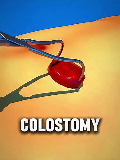 Understanding Colostomy Surgery and Its Impact