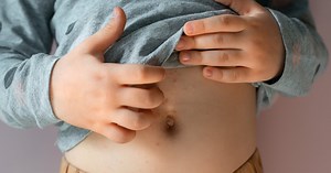 Chickenpox vaccine: who can get it, when and why?