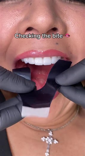 Zirconia Crowns Fitting Procedure