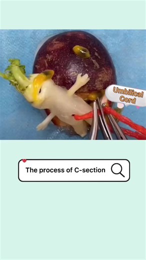 Understanding C-Section: The Surgery for Delivering Your Baby
