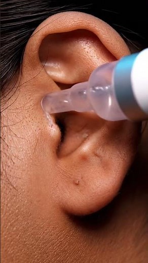 Satisfying Ear Pimple & Blackhead Removal” #blackheadcaique #skincare #satisfying #viral