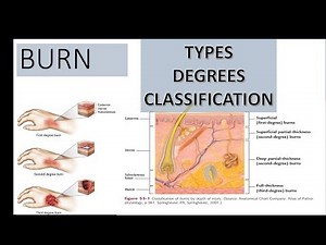Burn Part 1 - Types, Degrees and Classification