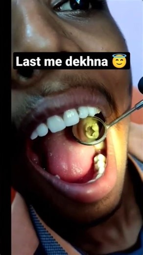 Root canal treatment |Root canal procedure|endodontic procedure |#dentatdoubts #rct