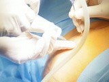 Adrenalectomía laparoscópica  • Vídeo • MEDtube.es