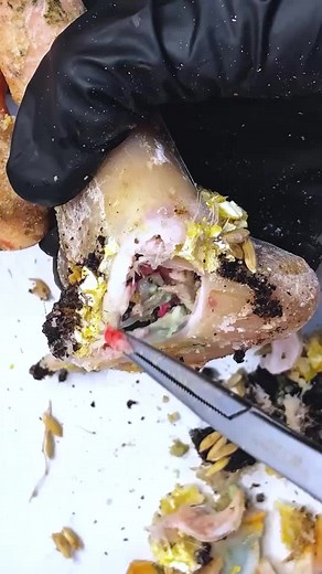 Unbelievable Toenail Fix in the USA! 🇺🇸 #USA #AmericanToenail #ToenailCare #SatisfyingNail #NailFixUSA #AmericanHealth #USAToenailCare #MadeInUSA #TrendingInUSA Disclaimer: These videos are sourced from other platforms, Video Credit to Vietnamese group. They feature artificial toenails for educational and monetization purposes.