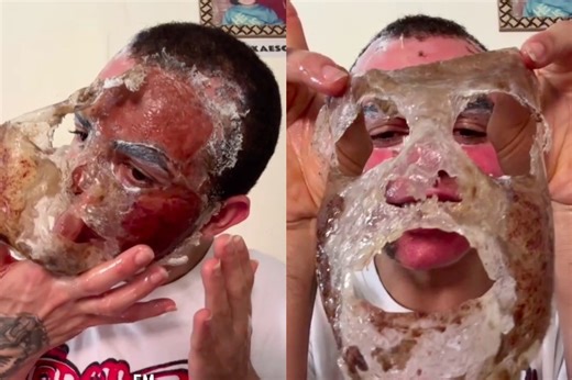 Phenol peels: The truth about the dangerous beauty procedure