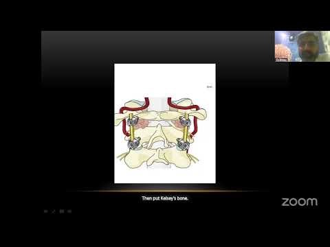Transarticular and Goel Technique for C1 & C2 | Rapid Clinical Review Series