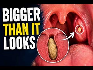 Tonsil Stones: How to Get Rid of Them Safely (And What NOT to Do)