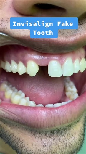 Camouflaging Missing Tooth with Invisalign: Fake Tooth Solution
