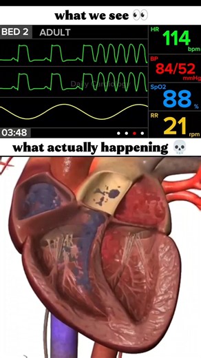 ECG changes during cardiac arrest with heart animation #ecg #cardiacarrest #icu #cardiology