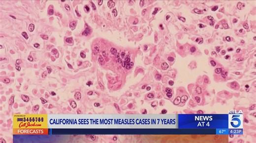 California sees the most measles cases in 7 years