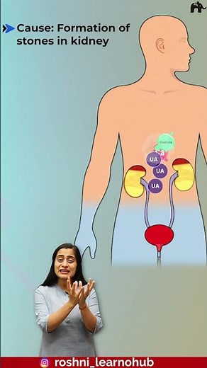 Kidney stones formation | Excretory products and their elimination Class 11 Biology with Roshni Mam