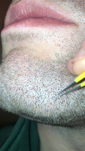 Beard pili multigemini | PickyNiki