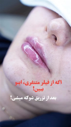 ‎ليزر سنتر(مطب پزشکی پوست و زیبایی ،لیزر مو📍زعفرانیه)Laser Center‎ on Instagram‎: "🔴نچرال تغییر کن🔴 یعنی چی؟؟ ‼️مدلی از تز. ریق ژل به لب است که در ان تغییر لب ها کاملا ط‌بیعی هست‼️ 🔴کسانی که تز. ریق فیلر لب طبیعی انتخاب میکنند افرادی هستند که می خواهند به لبهایشان به صورت طبیعی حجم بدهند. @lasers.center @lasers.center @lasers.center @lasers.center ‼️جهت استعلام ق‌یمت کلمه ( لب💋کامنت کنید.⁩⁩⁩‼️ ارتباط با کارشناسان ☎️۲۲۱۷۹۴۹۲ ☎️۲۲۱۸۷۲۶۴ #فیلرلب #لیفت_گونه #جوانسازی_دور_چشم #زعفرانیه"‎