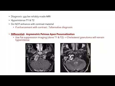 Petrous apex lesions