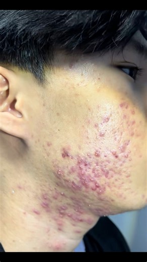 72K views · 368 reactions | Purify, renew, and glow . Our acne facial is the reset button your skin has been waiting for.” | Thảo Dược Trị Mụn - Trắng Da | Facebook